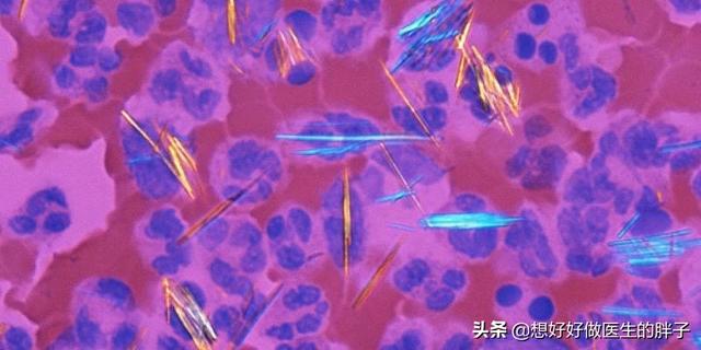 辟谣尿酸高就一定会引发痛风,辟谣痛风