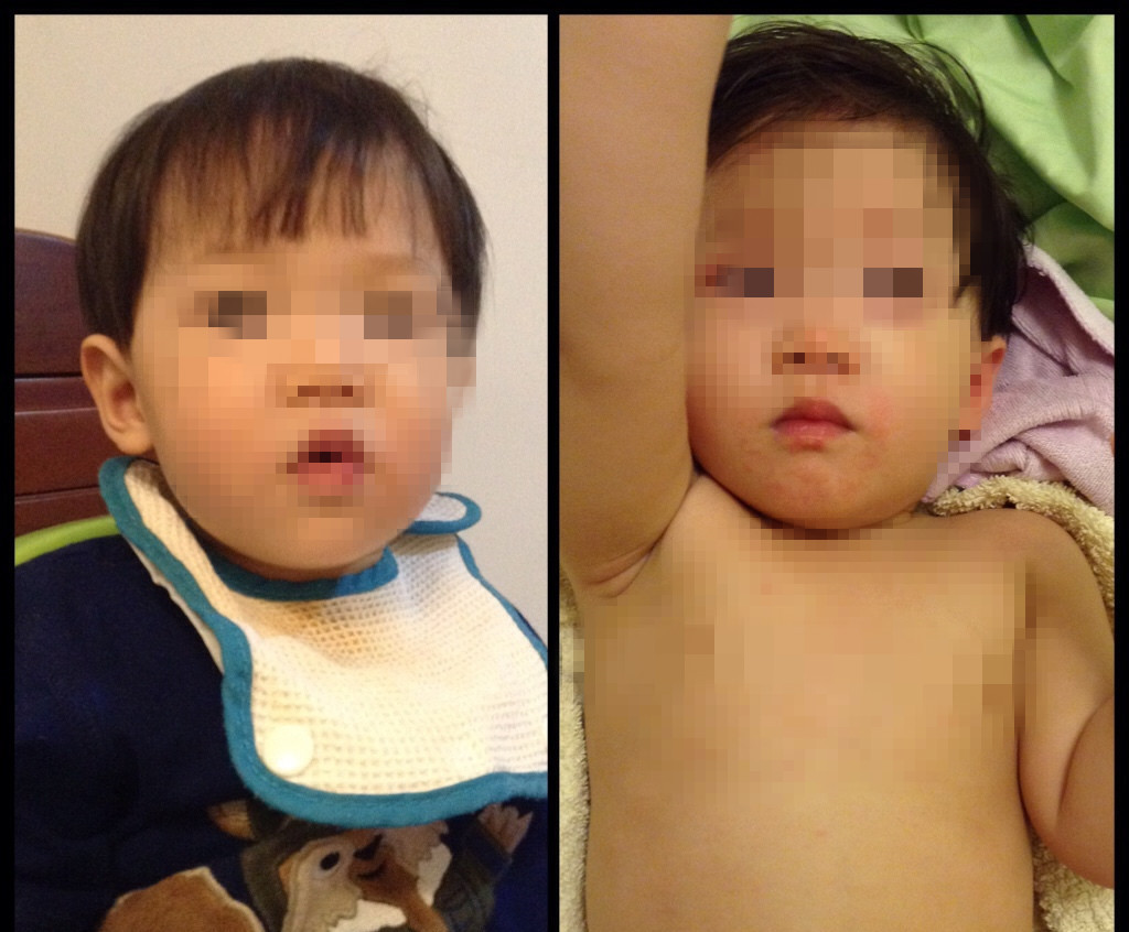 宝妈含泪讲述宝宝川崎病,川崎病为什么一定要发烧超过5天