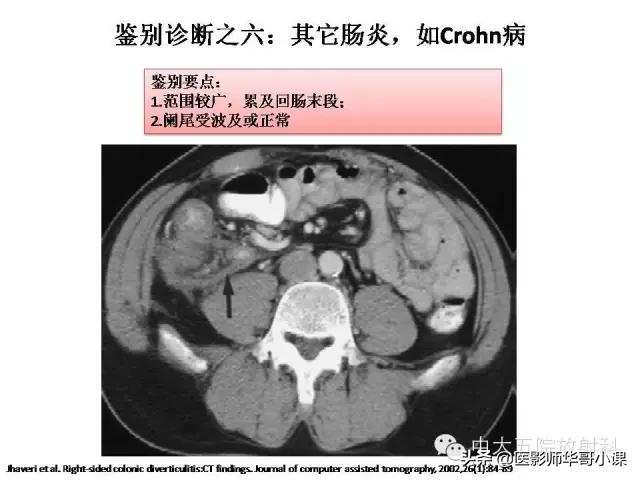 阑尾炎课件,阑尾炎的超声课件