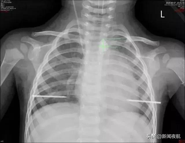 小孩误吞了玻璃碎渣有啥反应,如何判断小孩有没有误吞玻璃