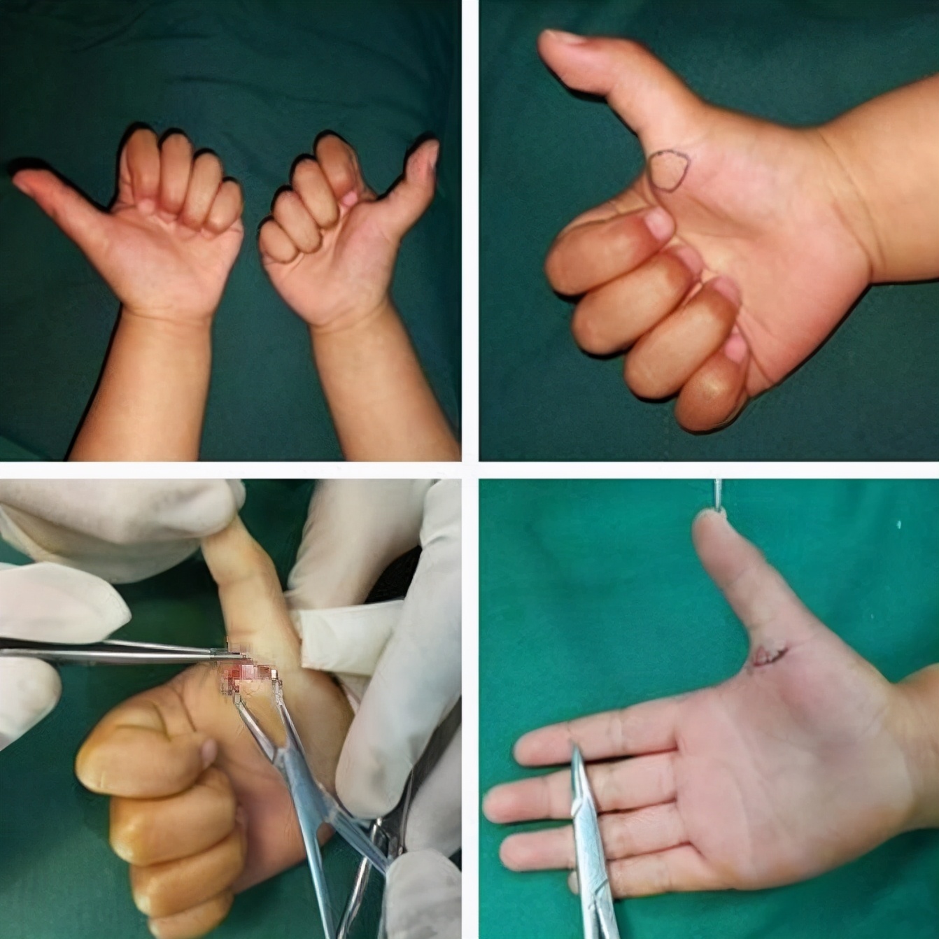 小儿狭窄性腱鞘炎应该怎么办？