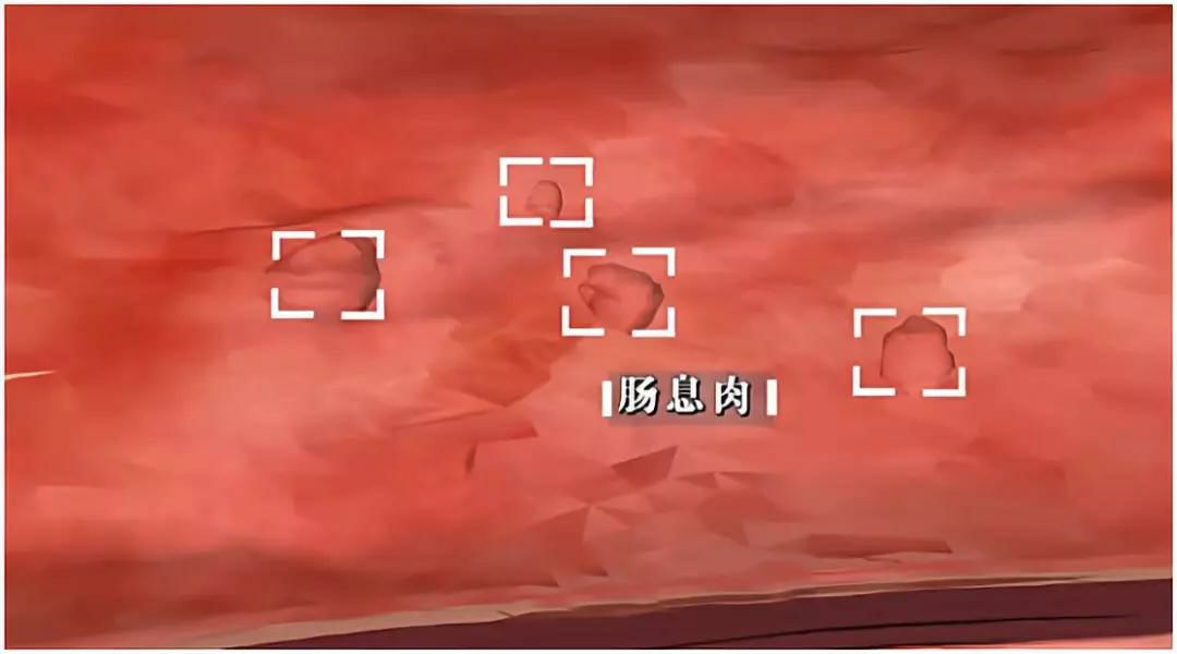 肠癌出现症状往往就是晚期吗,为什么肠癌一发现就是晚期