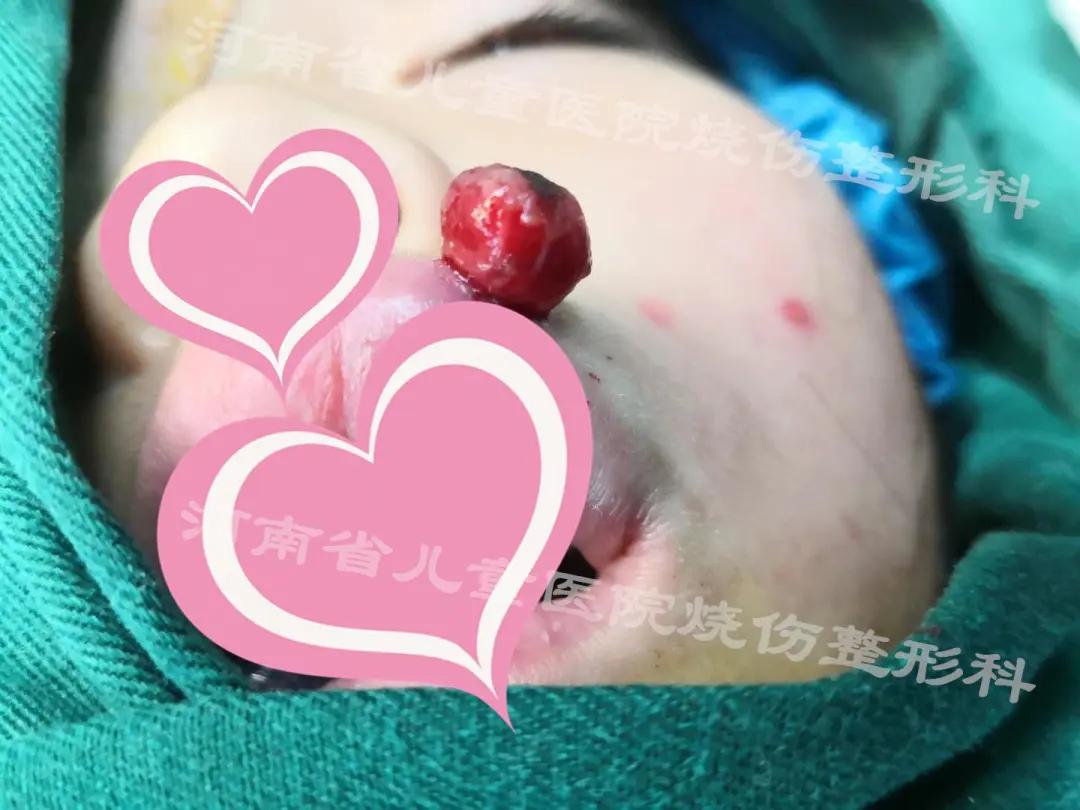 嘴唇上有红色的小血点出血止不住,嘴唇上小红点流血不止