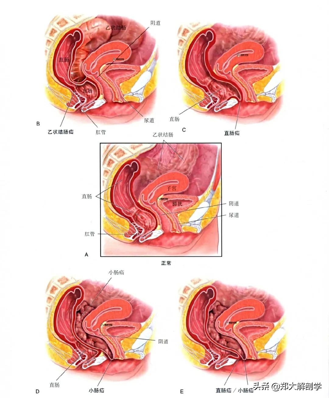 女性盆底功能障碍性疾病表现,盆底功能障碍会引起失眠吗