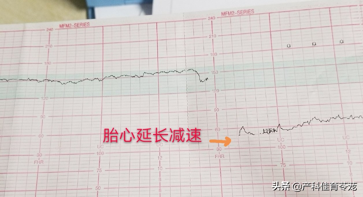 胎心监护脐带受压怎么解决,做胎心监护能看出来脐带问题吗