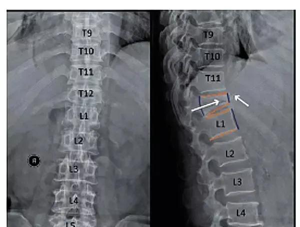 胸椎压缩性骨折腰椎疼是怎么回事,胸椎压缩性骨折打喷嚏腰痛正常吗