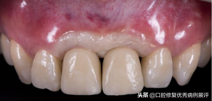 展评优秀病例赏析|Asc全瓷角度基台一体冠进行种植前牙美学修复