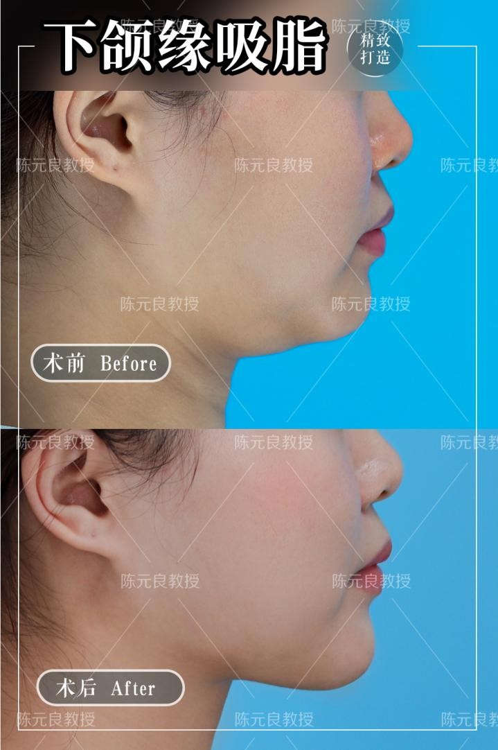 面部吸脂肿成猪头图,面部吸脂后一个月恢复图片