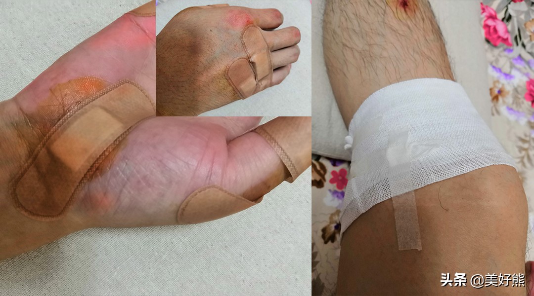 软组织损伤可以用艾灸吗,软组织挫伤艾灸有效吗