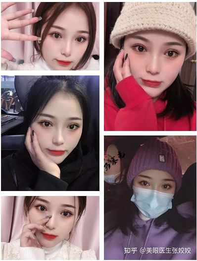 有没有割过眼袋后悔的,肿眼泡割双眼皮后悔率