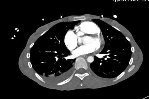 重度高碳酸血症突出表现,出现消化系统疾病的临床表现