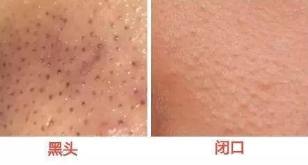 去黑头攻略：被黑头耽误的鼻子是该处理一下了