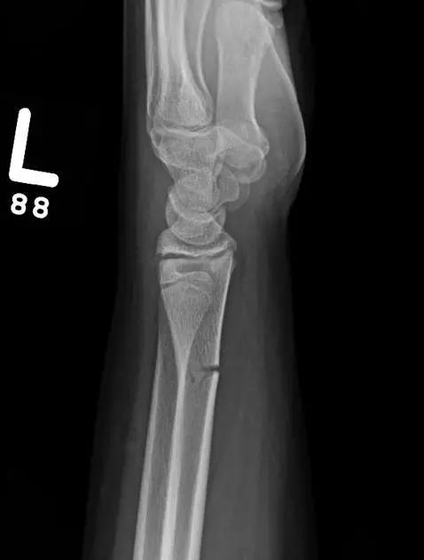 所有骨折都叫什么名字,骨折的名称有哪些