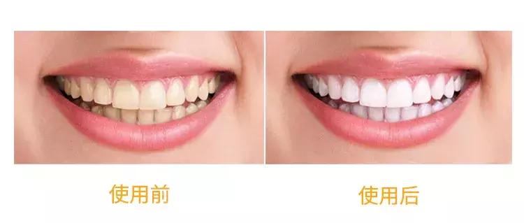 一口黄牙能洗白吗,一口黄牙毁了一张脸