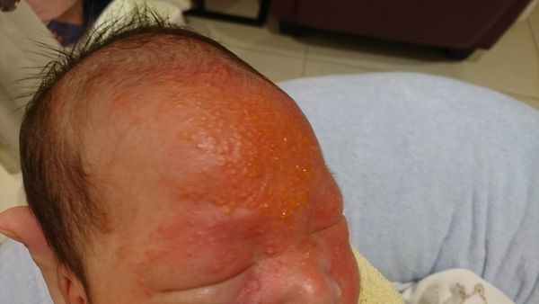 新生儿脂溢性皮炎怎么治疗最彻底,新生儿脂溢性皮炎用什么护理