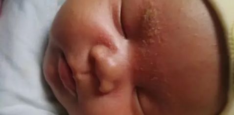普及！宝宝湿疹不敢用药怕激素？湿疹护理指南来帮你