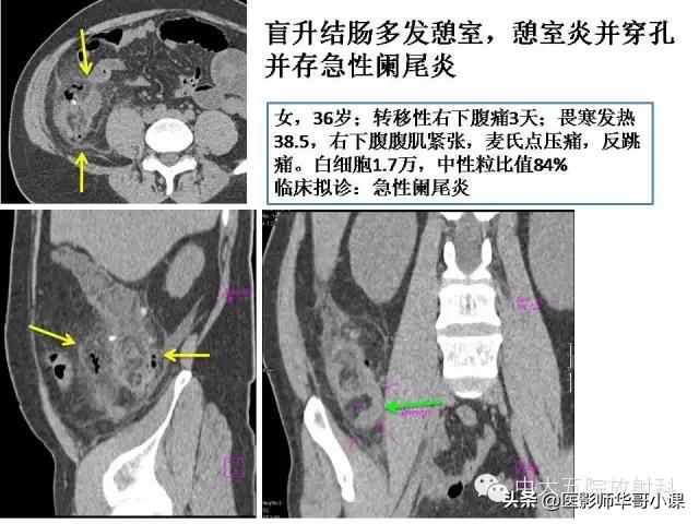 阑尾炎课件,阑尾炎的超声课件