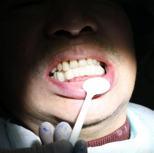 缺牙处牙槽骨萎缩邻牙受影响,60岁老人缺牙怎么治疗好