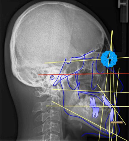 骨性龅牙和牙性龅牙的区别,牙性龅牙和骨性龅牙怎么矫正