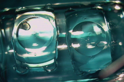 第一人称体验近视手术,晶体植入近视手术亲身经历