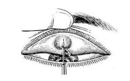 眼睛肿包警惕麦粒肿，麦粒肿是什么？吃什么帮助缓解？