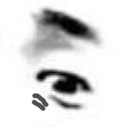 眼睛有深纹怎么办,眼睛上出现细纹怎么办