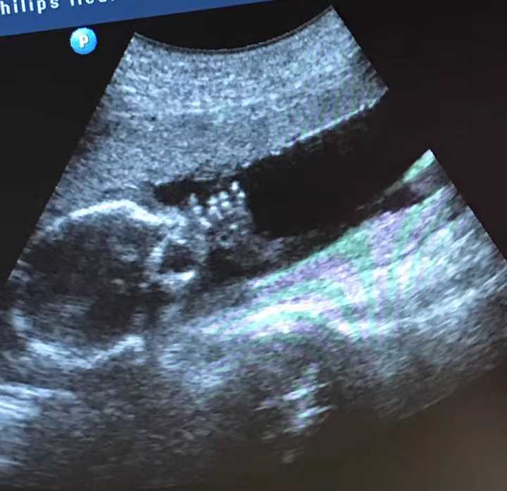 二胎宝妈两次怀孕，没发胖没变丑，工作带娃还旅行，看完不恐孕了