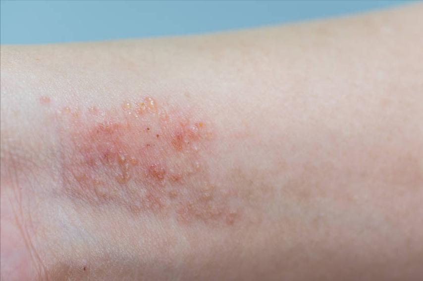 激素治疗牛皮癣有什么危害,治疗牛皮癣的针剂有哪些危害