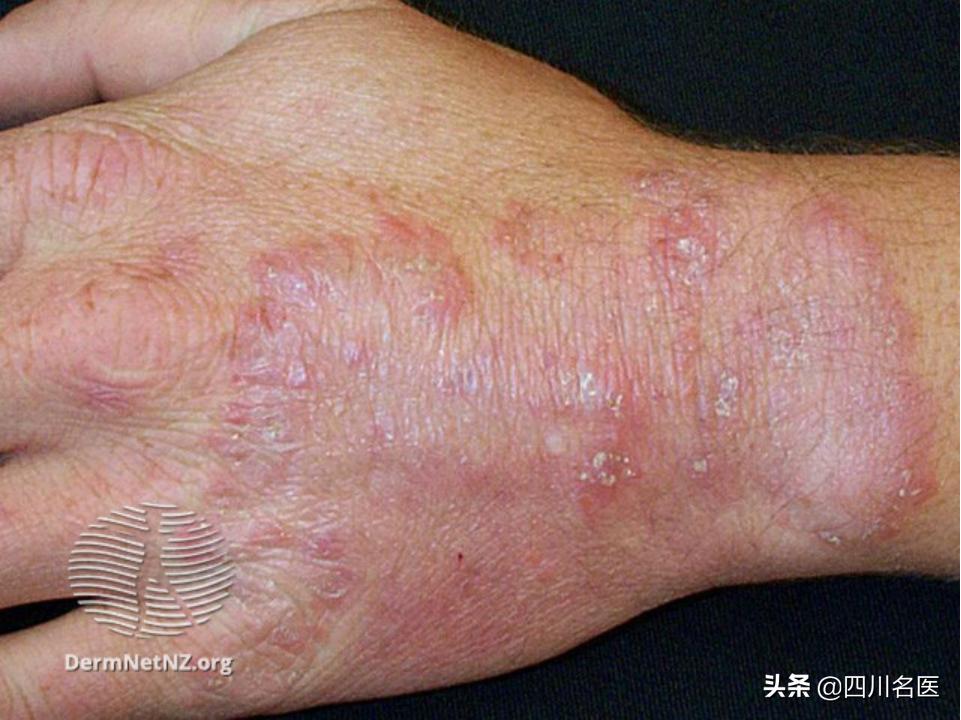 你的手指上为什么会脱皮,您的手为什么会脱皮