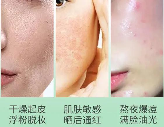 日本抗痘护肤品牌,日本护肤品淡斑美白排行榜