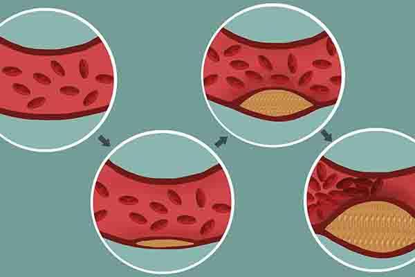 乳腺癌骨质疏松会导致骨转移吗,乳腺癌病理性骨折还能活多久