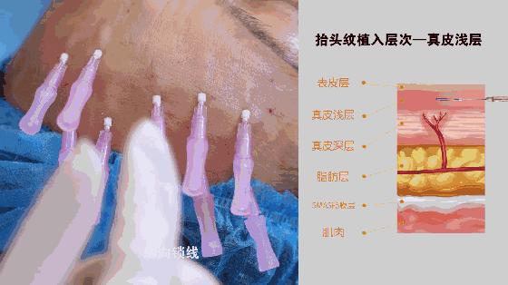 埋过线还能做拉皮吗,面部埋线提升颧骨变得很高怎么办