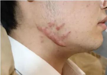 下颚痘痘反反复复是什么原因,下颌线上的痘痘反反复复怎么治