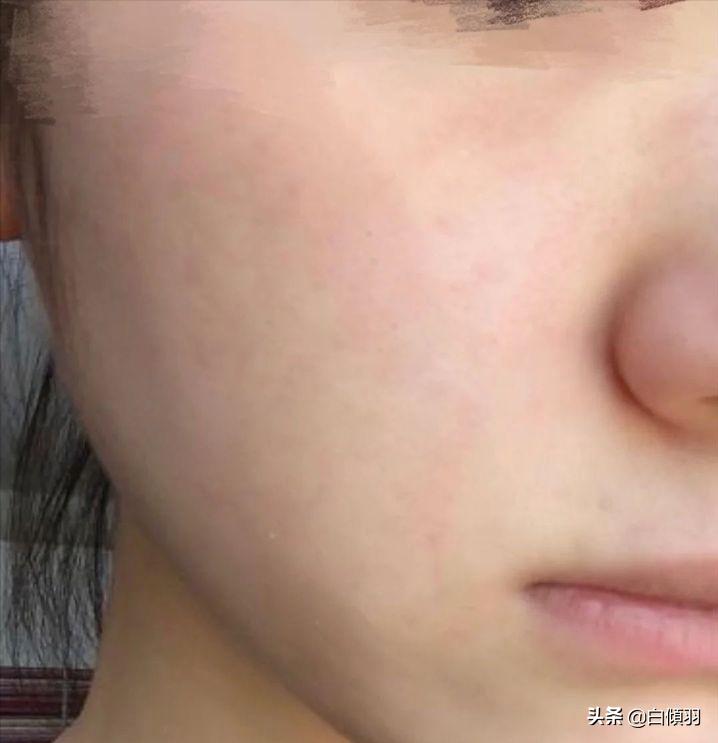 红肿硬块痘痘没有脓怎么快速消退,红肿痘痘不疼了但是还是有包