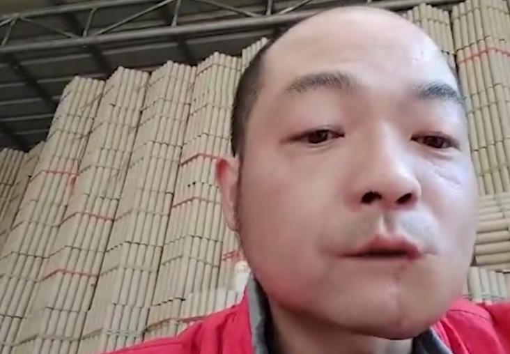 湖南小伙吃槟榔30年致癌,湖南小伙吃槟榔被切半张脸