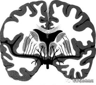 体检发现脑梗要住院吗,体检查出腔隙性脑梗塞需要治疗吗