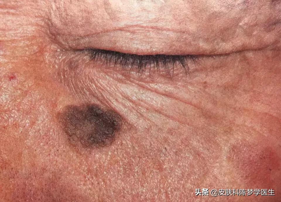 色斑和褐斑,根治面部黑褐斑的方法