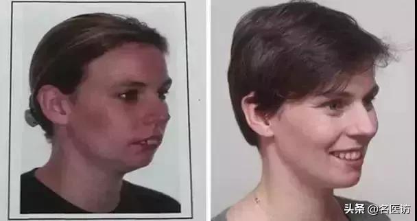 牙齿矫正换脸视频,牙齿矫正颜值有多大改变图片