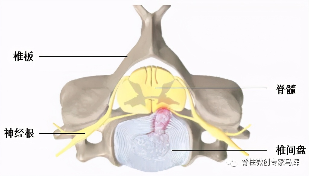 脊椎压迫神经做了微创术后腿麻疼,神经根损伤疼痛治疗
