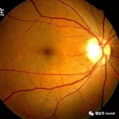 hiv感染症状及表现会口干吗,hiv的症状有眼睛红吗