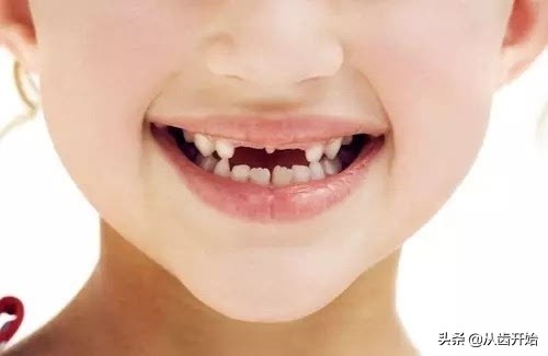 孩子换牙期间怎么做牙齿整齐,孩子换牙期一定要知道四个忠告