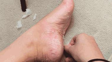 得了湿疹,得了湿疹身上的伤就没好过