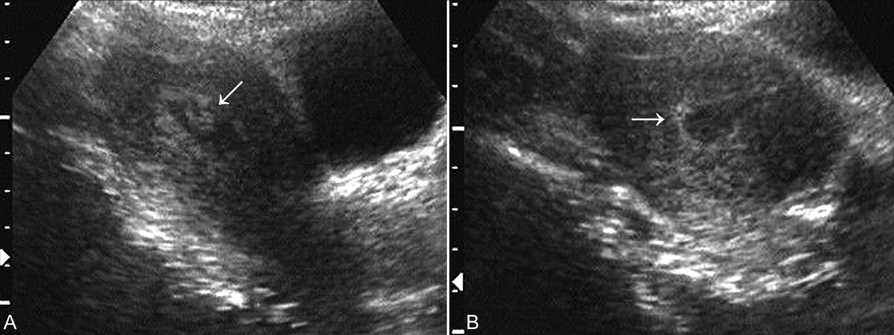 明明白白做超声32-3:流产:超声检查