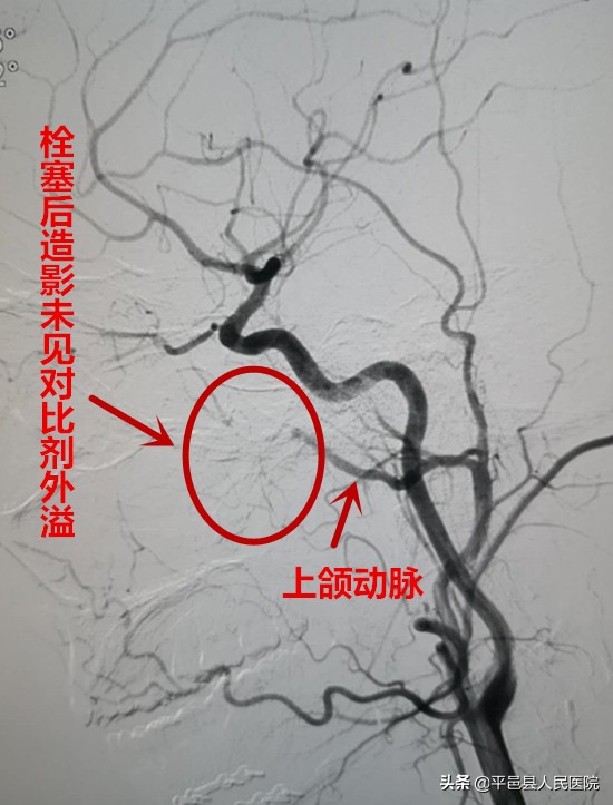 鼻出血止血的方法有血管栓塞法吗,介入治疗鼻出血是怎么操作