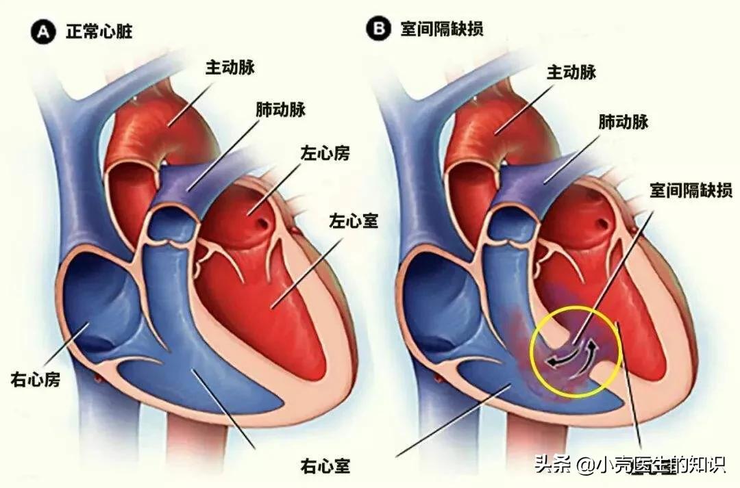 室缺多少属于严重的,室缺宝宝有什么症状
