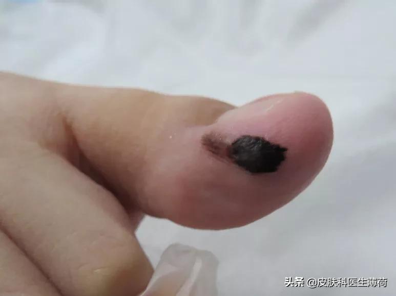 富贵痣点掉了,有福的痣点掉