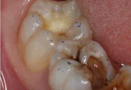 补牙学问,补牙真的是小洞不补大洞吃苦吗