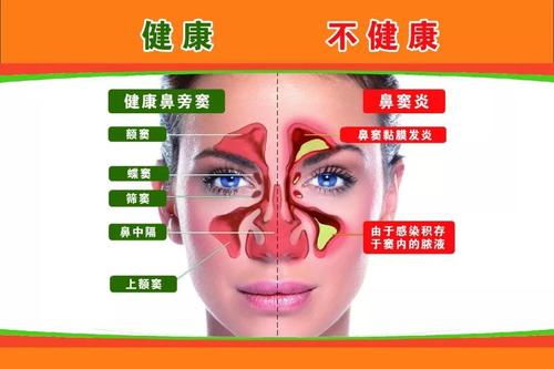 鼻窦炎的元凶已揪出,鼻窦炎的诱发因素