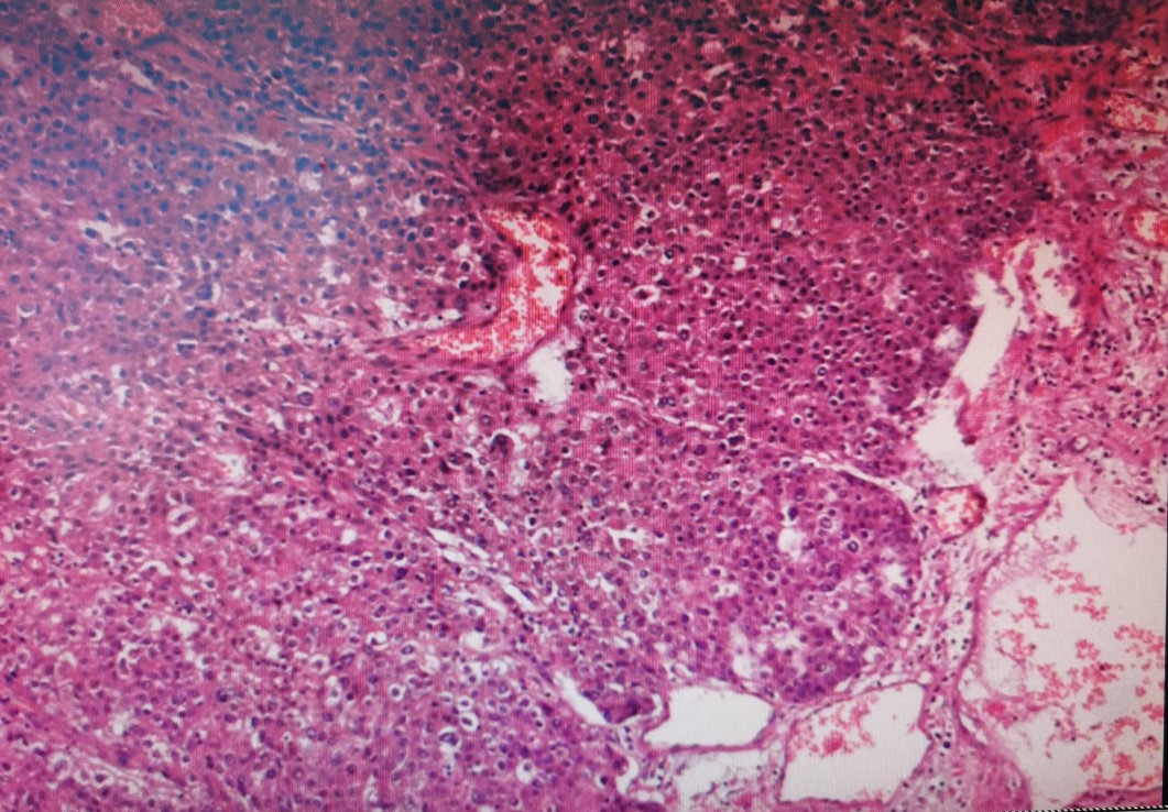 贲门癌吐血抢救,中国最著名的贲门癌治疗专家