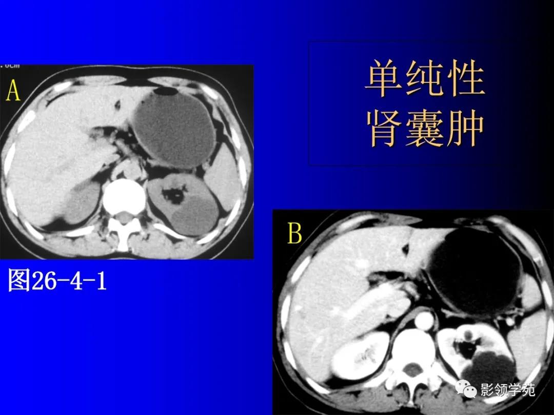 肾脏囊性肿块的影像学特点,肾脏典型病理图片及解析
